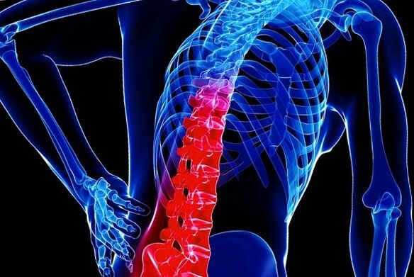 Reasons for the development of thoracic osteochondrose