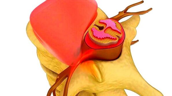 osteochondrosis of thoracic spine to the essence of the disease