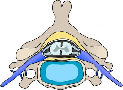 Protabius in spine with cervical osteochondrose