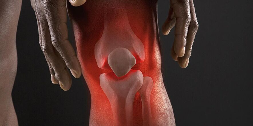 Burning sensation in the area of ​​the knee symptom is gonartrosis
